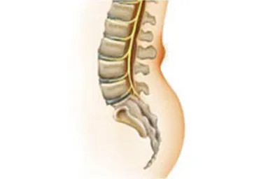 Spina bifida occulta